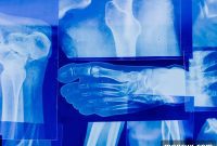 Ultimate Bone Health: Key Nutrients, Supplements, and Herbs